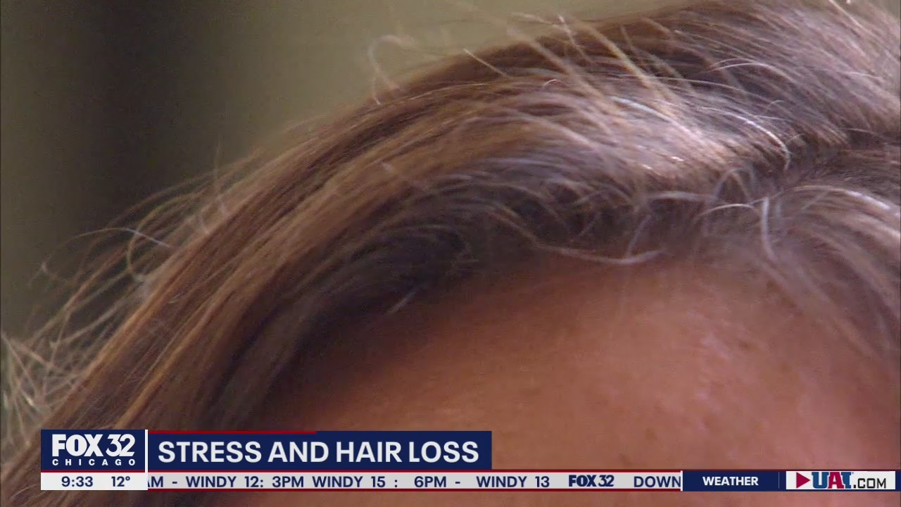 More people reporting hair loss due to stress during the pandemic