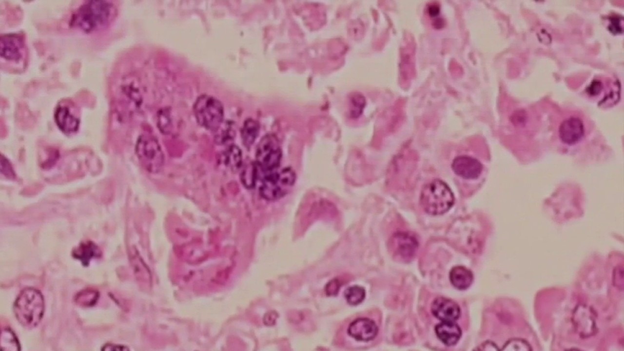 Measles exposure warning at LAX 