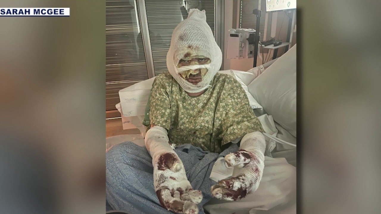 Gas line explosion leaves man with severe burns