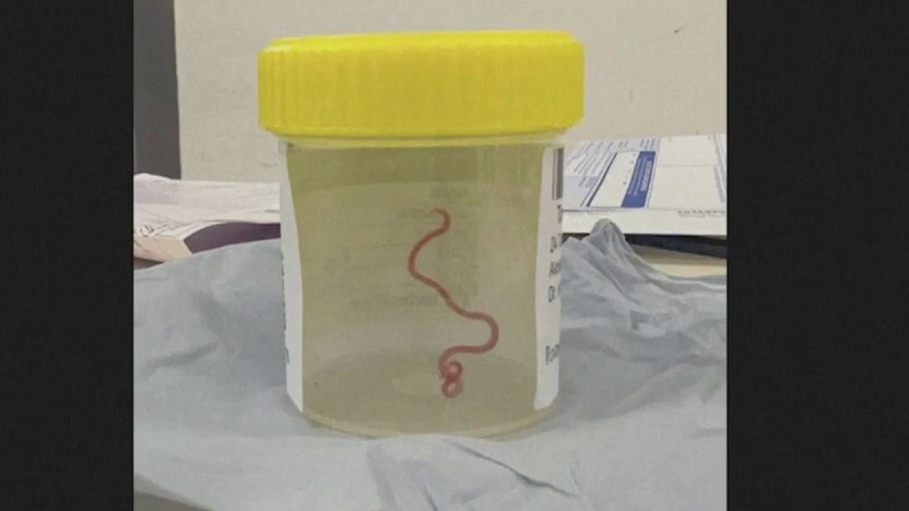 Worm found in woman's brain