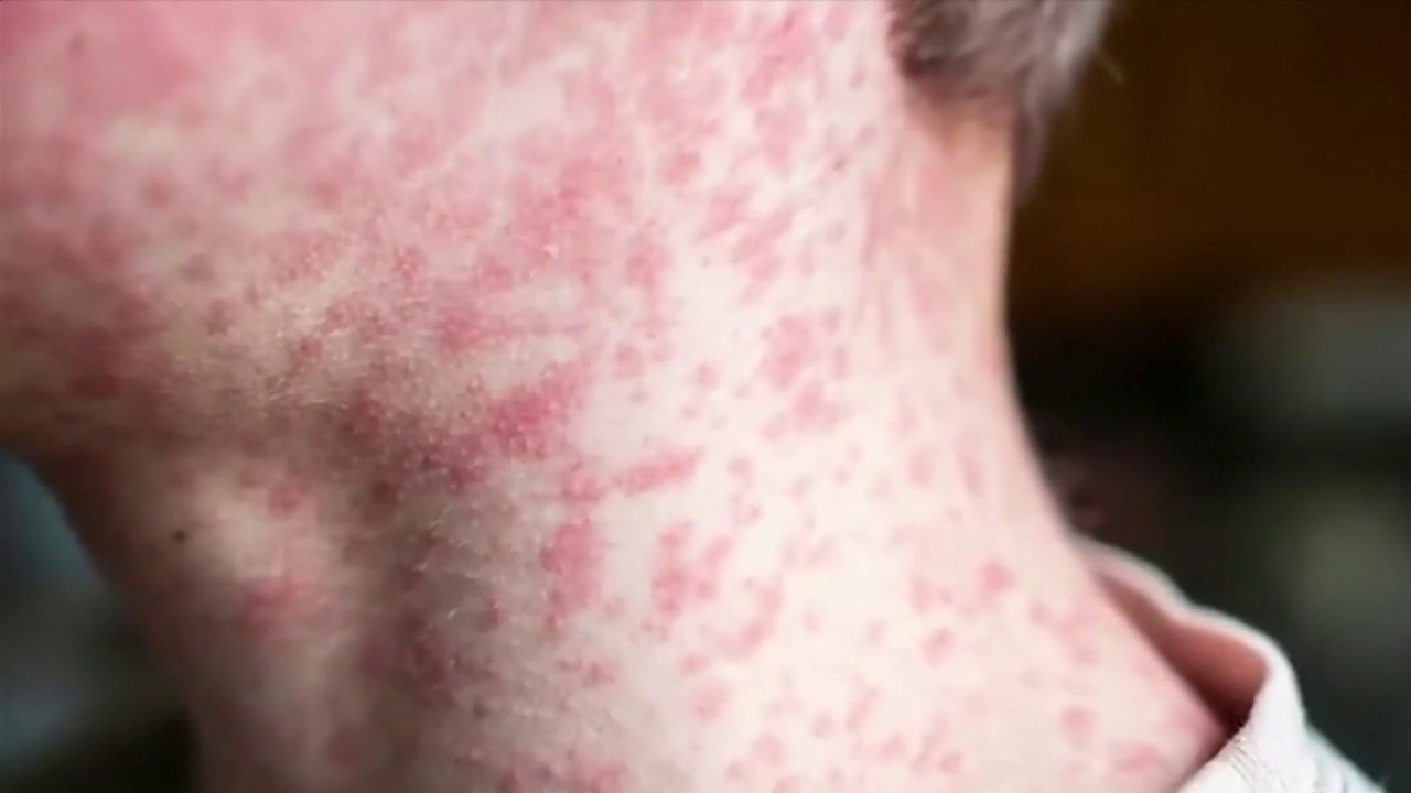Measles cases on the rise: What to know