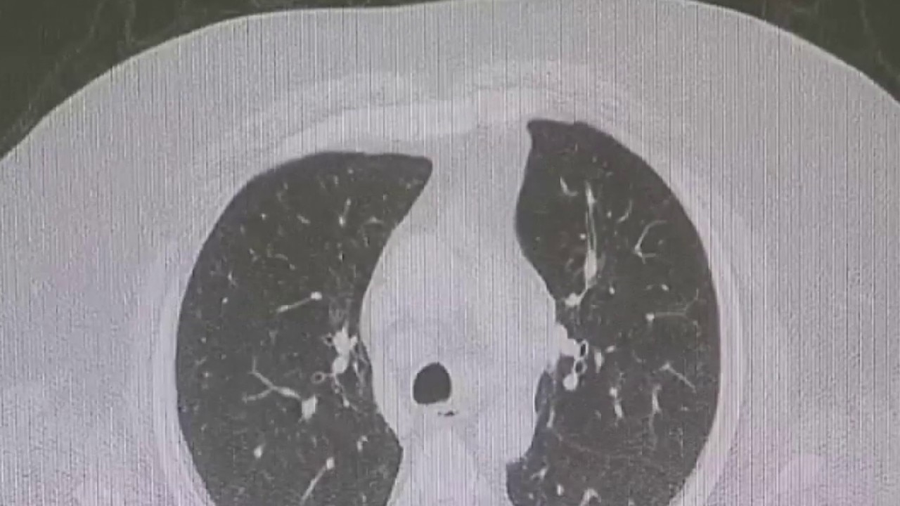 Lung cancer: Early detection and treatment