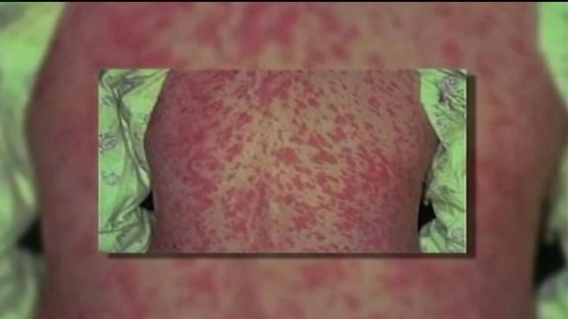 "We will probably see a case or two in the region:" Health officials prep for a measles outbreak in WI