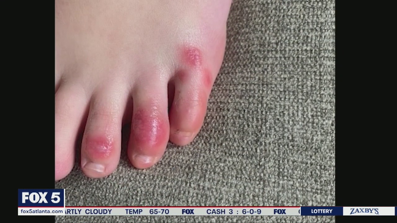 COVID Toe among odd symptoms of coronavirus