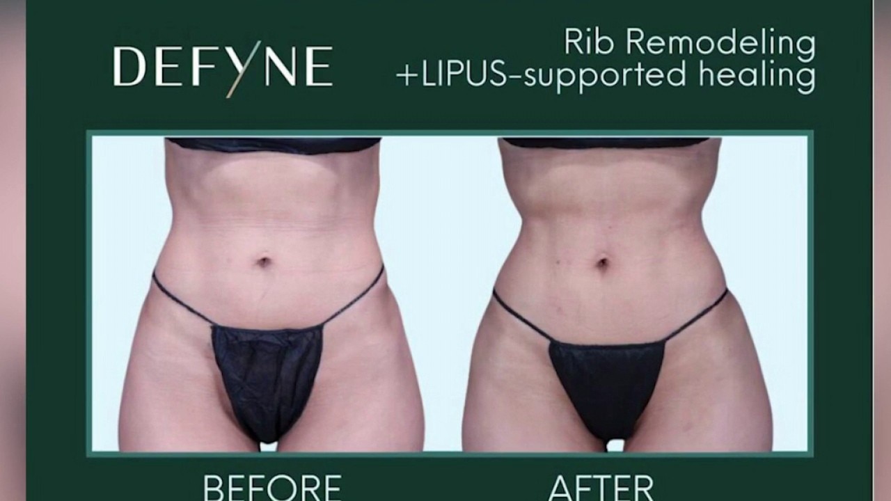 Scottsdale plastic surgeon one of the first to offer rib remodeling