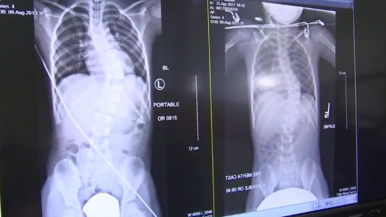 Scoliosis signs that parents shouldn't ignore