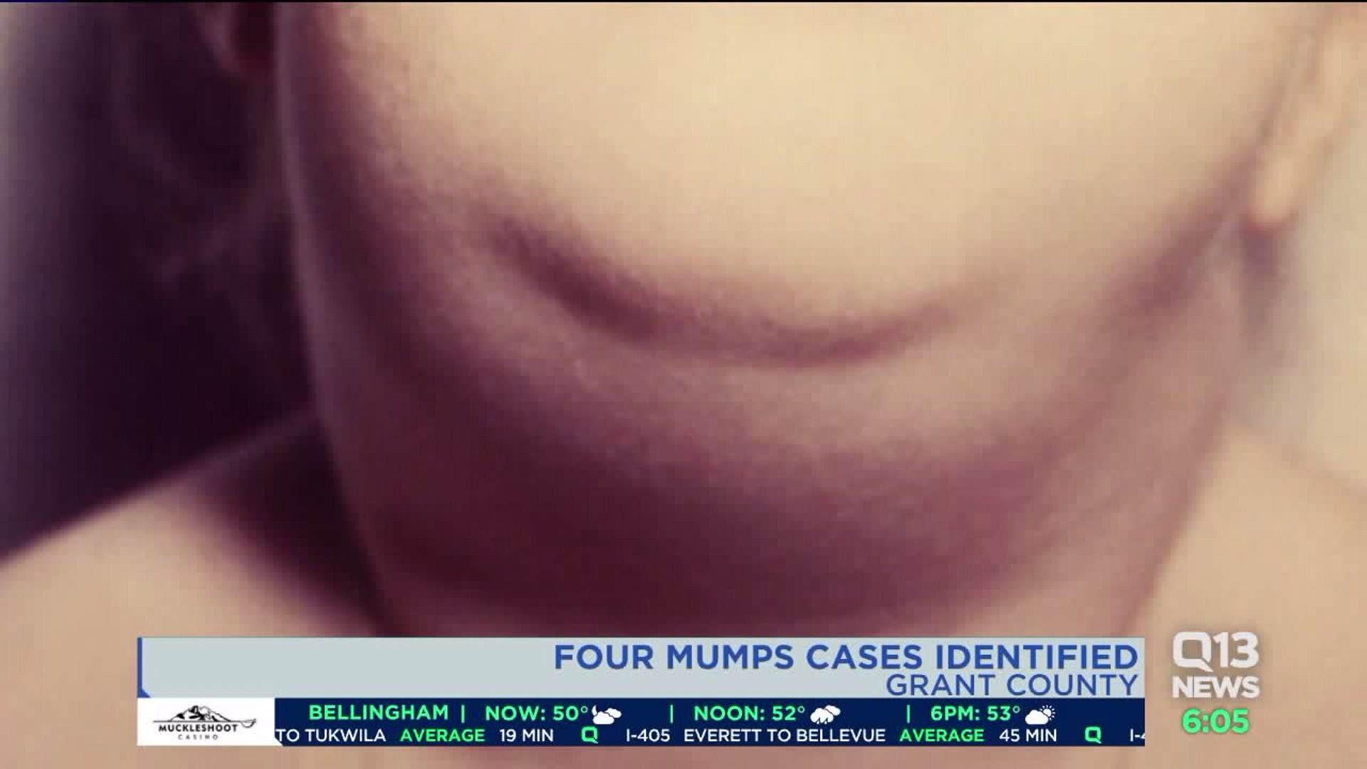 Mumps cases identified in Grant County