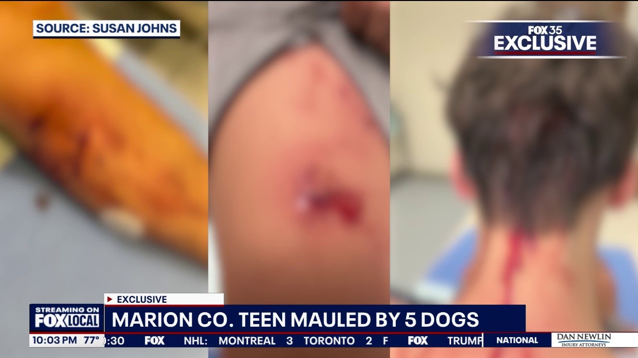 Teen recovering after attack by five dogs, father recounts rescue