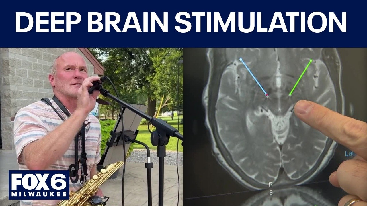 Deep brain stimulation helps Hartland musician with Parkinson's