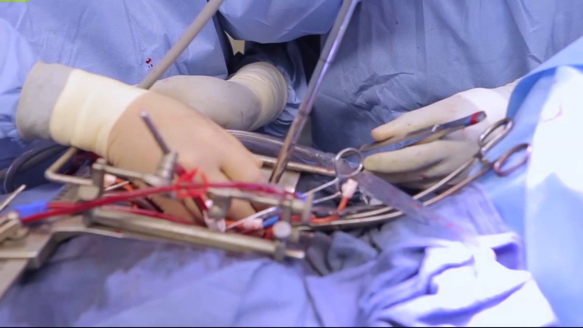Heart surgery questions