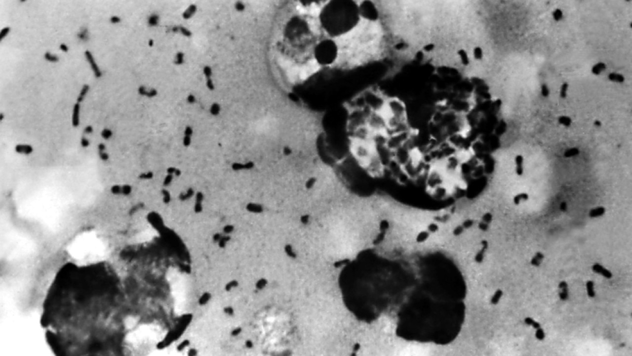 Suspected pneumonic plague case in Russia: Doctor explains what to know