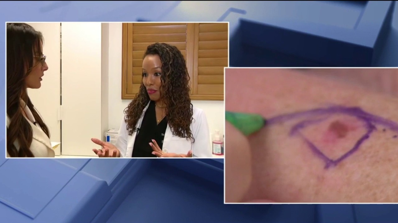 Mindful Monday: Melanoma Monday
