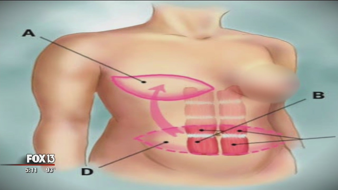 Reconstructive surgery without the implants