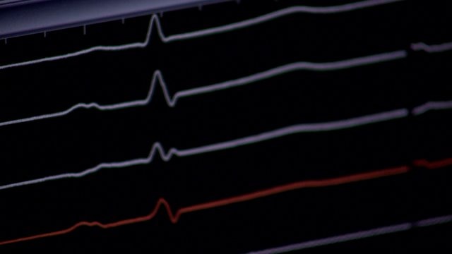 There are medications, procedures to correct irregular heartbeats; but what if those don`t work?