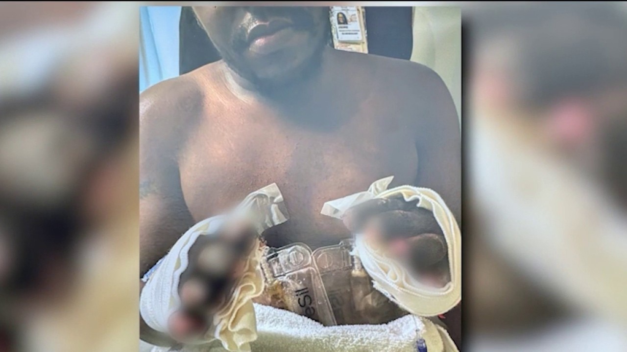 GBI investigating Fulton jail after inmate's limbs removed