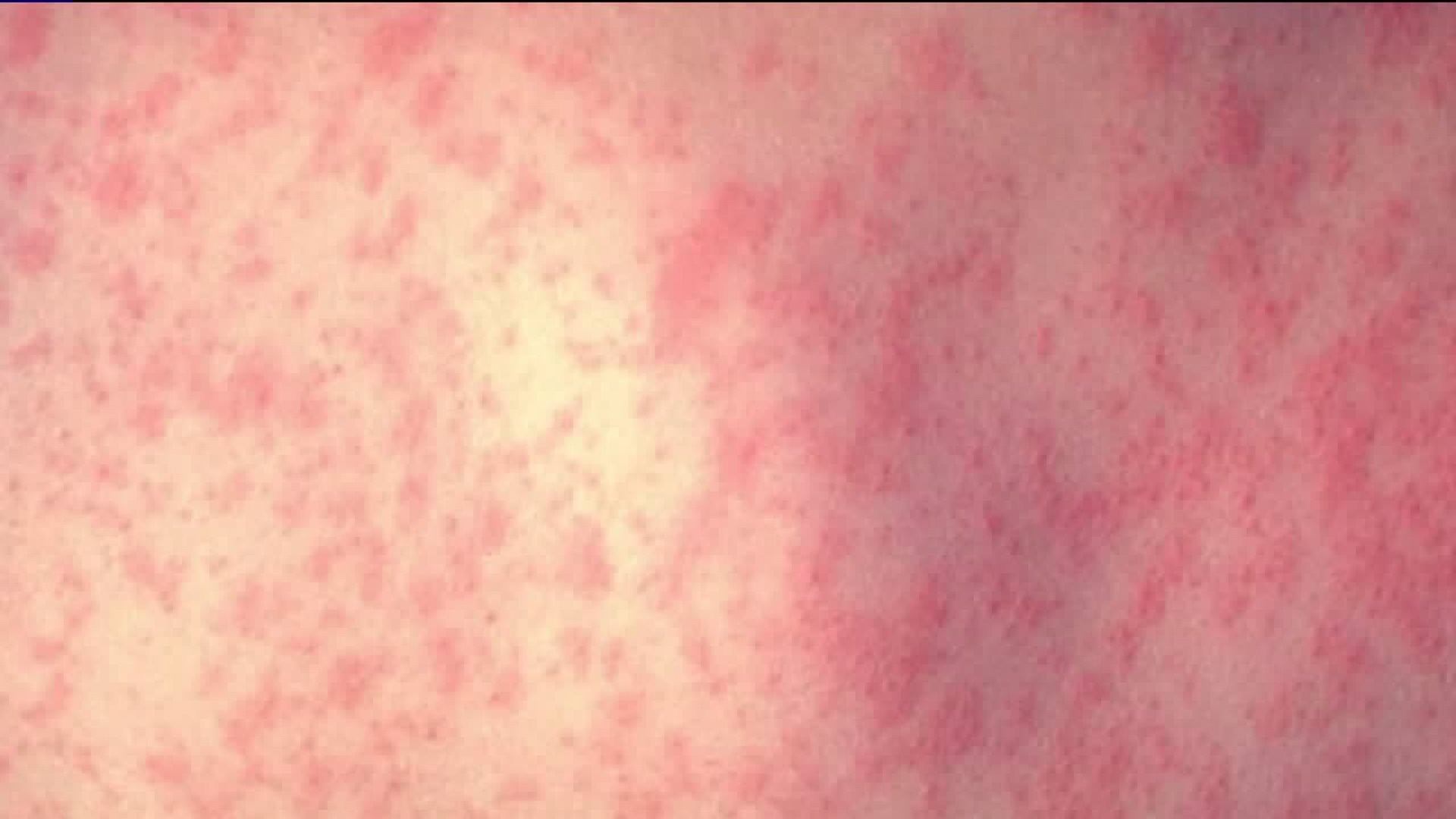 King Co. investigating measles case