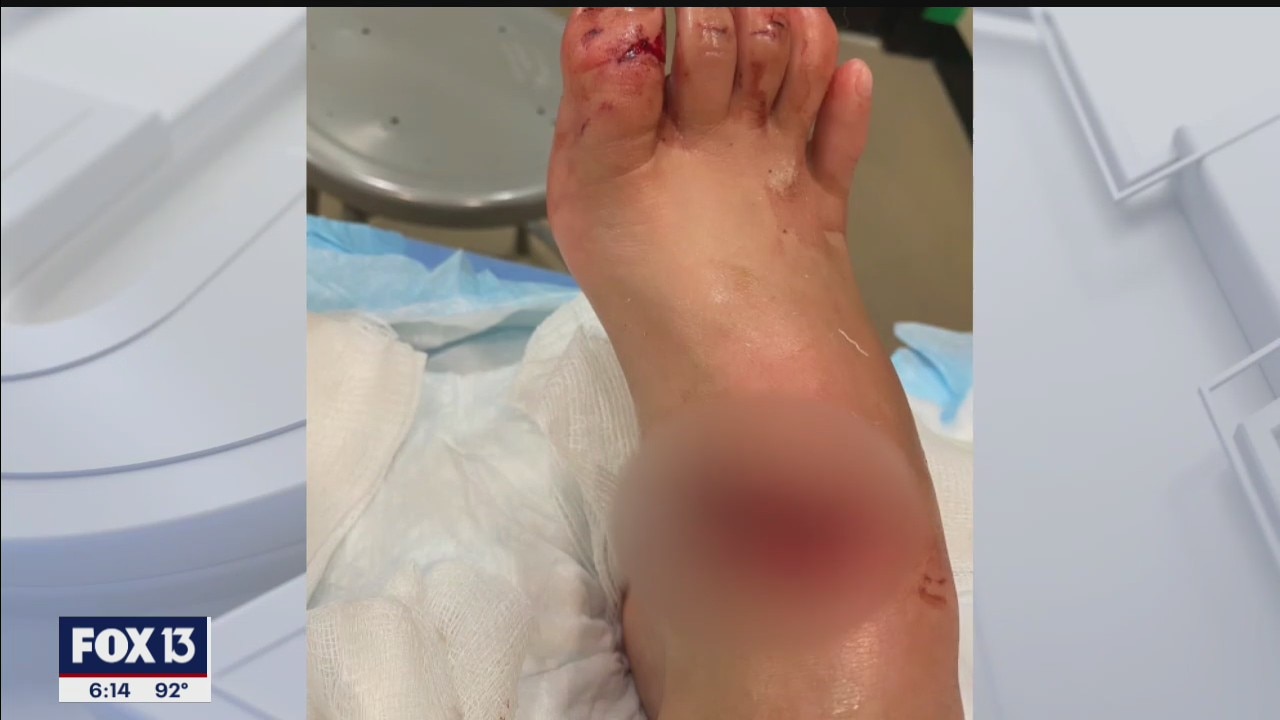 Lake Wales boy bitten by shark