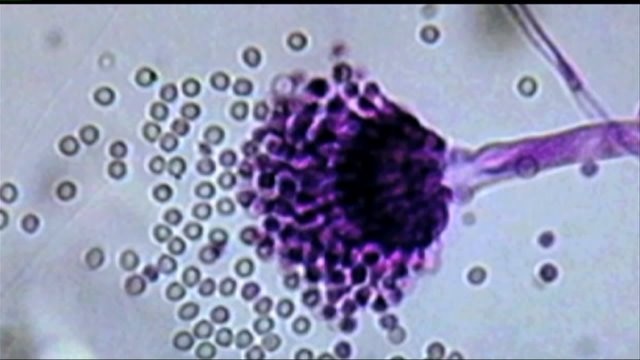 City of Milwaukee Health Department reports case of bacterial meningitis