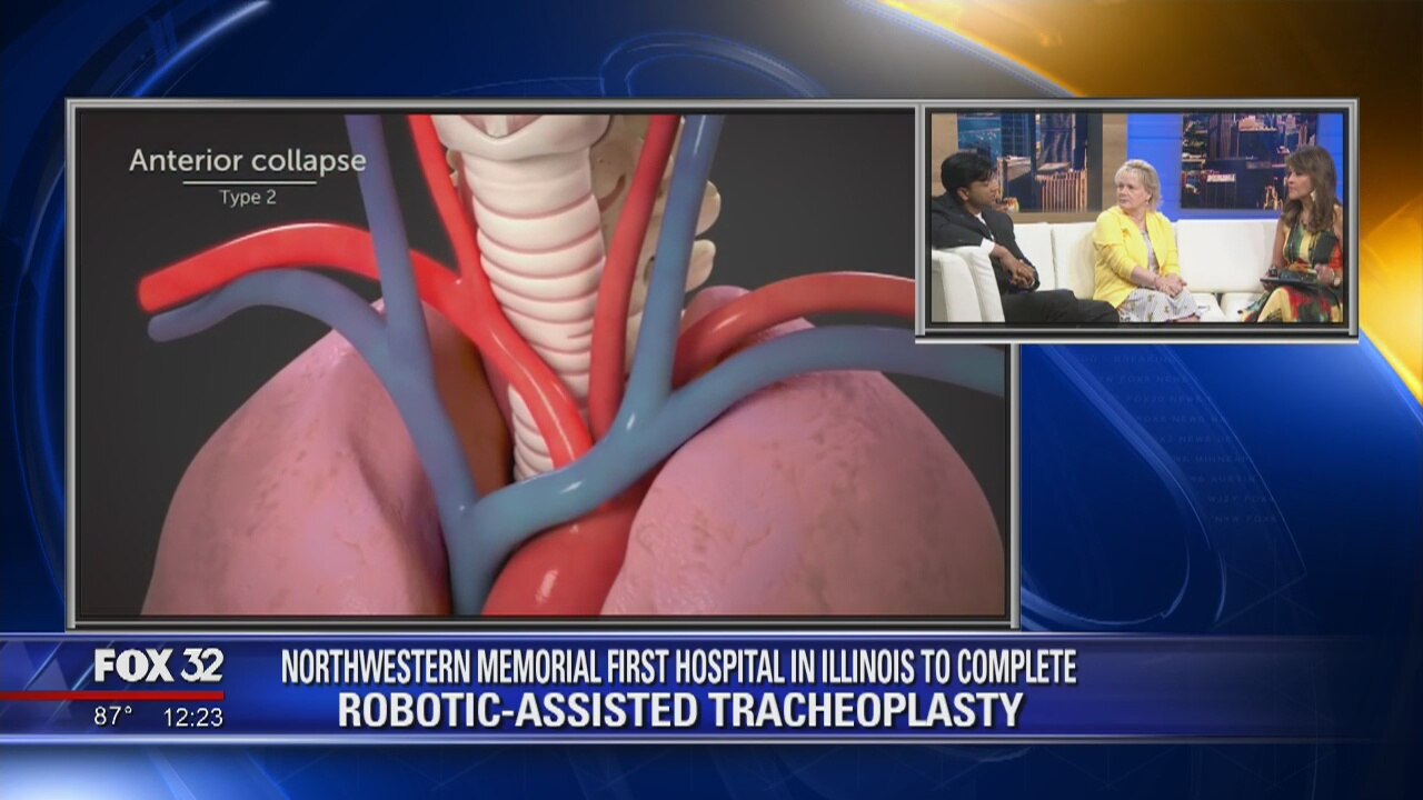 Northwestern Memorial Hospital achieves first robotic-assisted tracheoplasty in Illinois