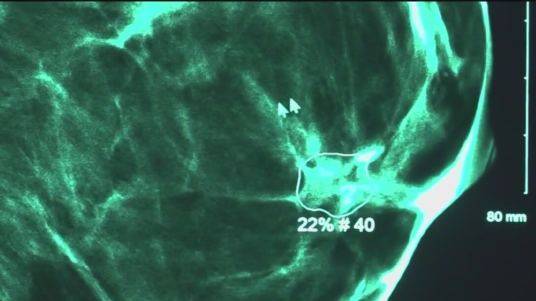 Doctors use AI to detect breast cancer earlier