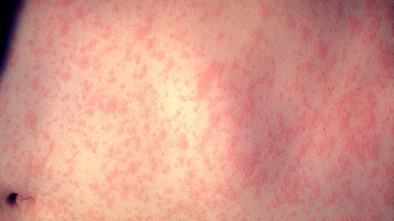 DuPage County confirms first measles case of 2026