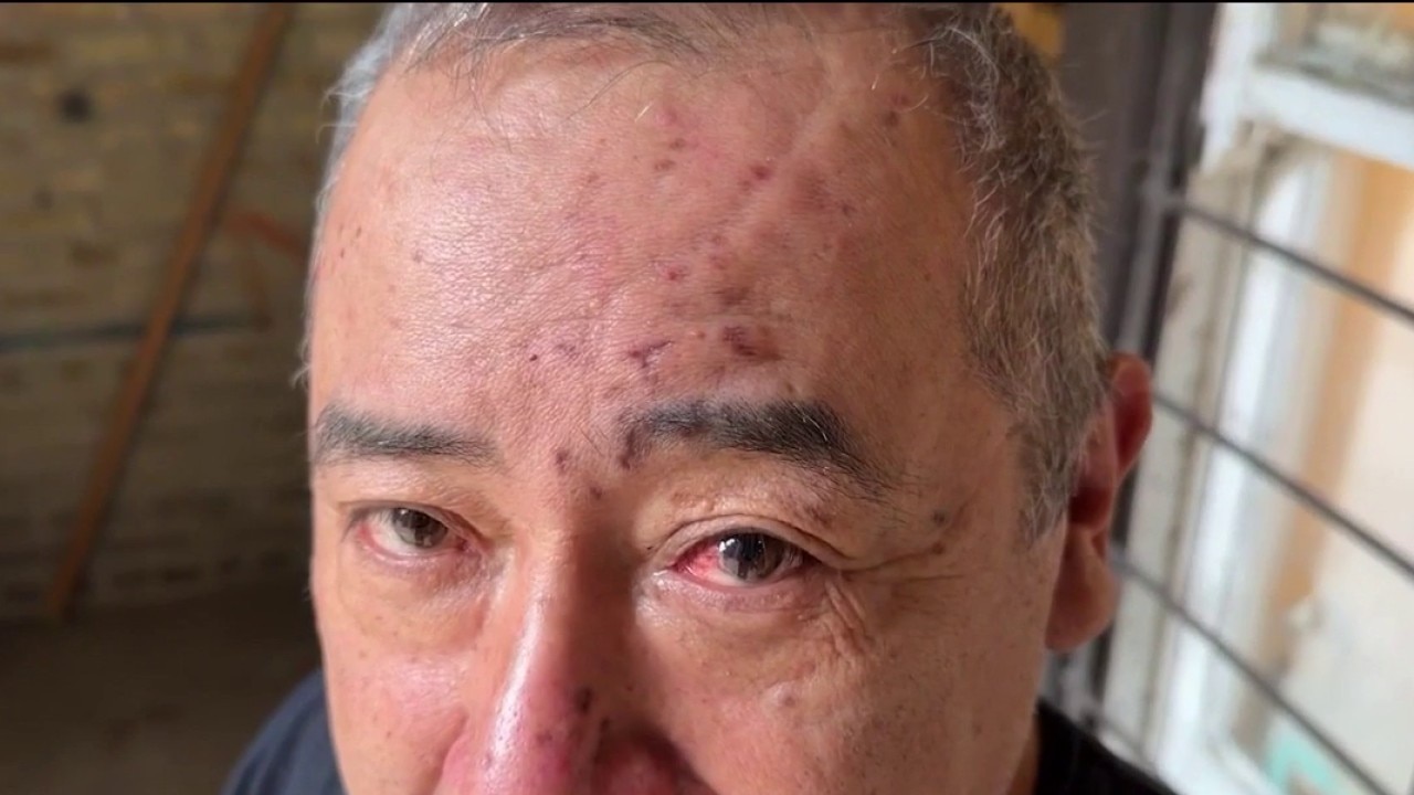 Rats bite sleeping Rogers Park apartment tenant's face