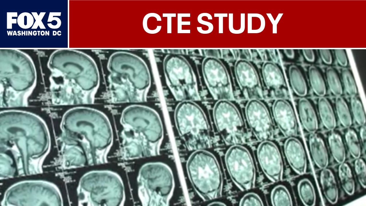 Study finds 1 in 4 former NFL players had CTE at death
