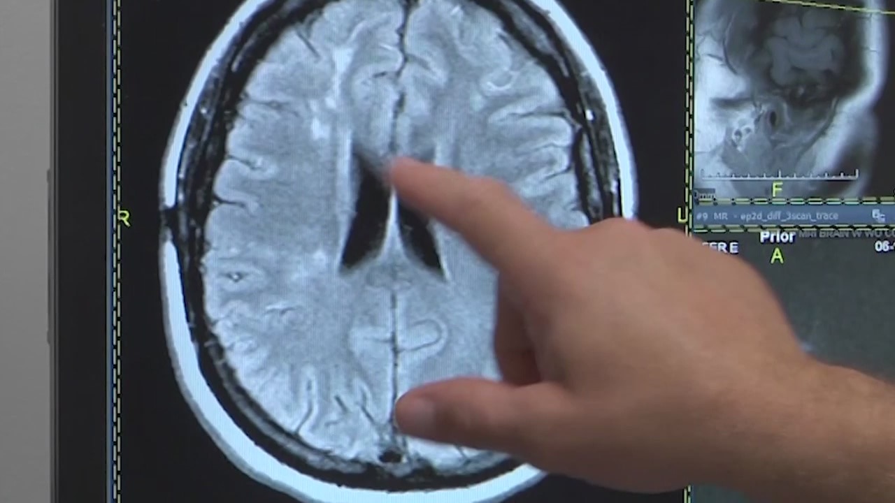 Health experts reveal stroke symptoms to look out for as young patients are on the rise