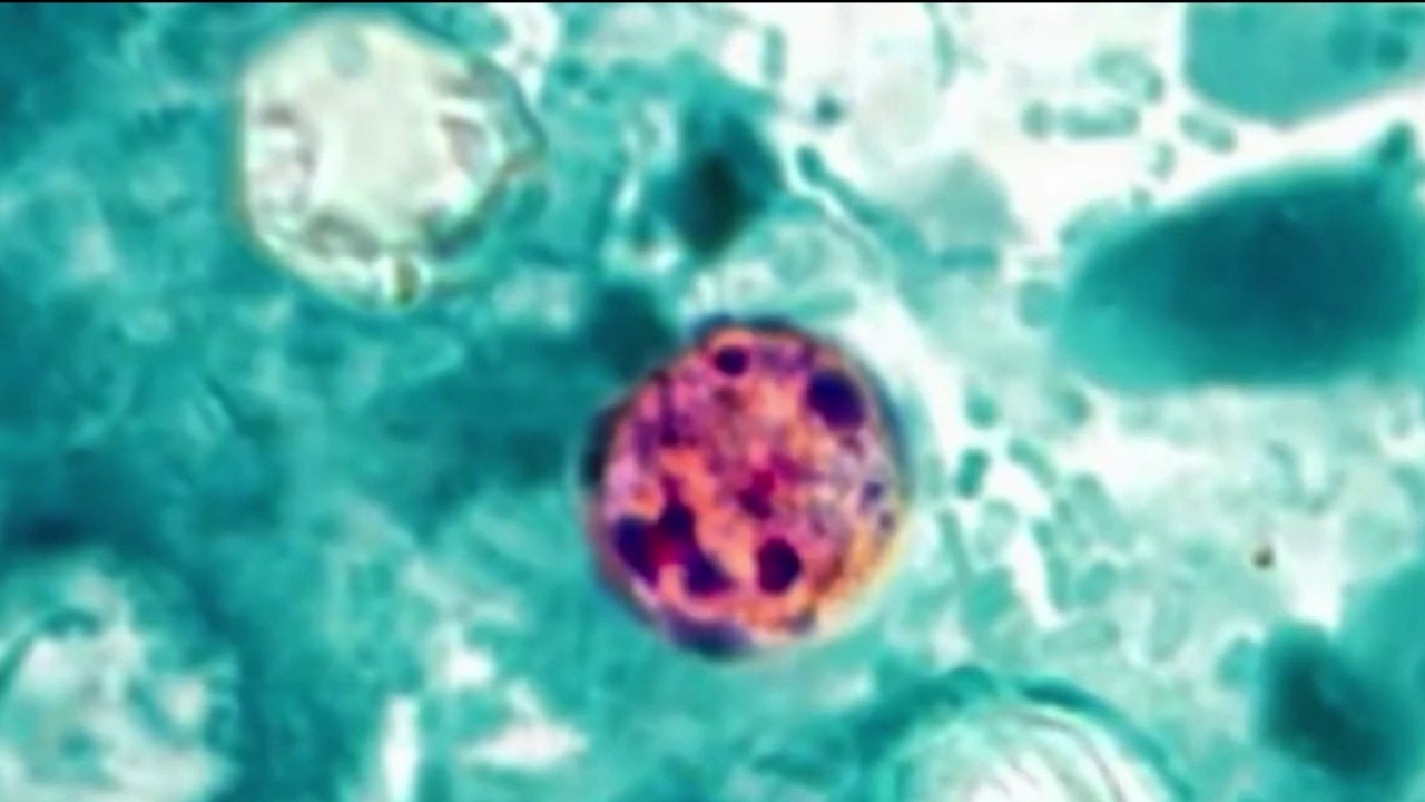 Record Cyclospora outbreak fueling food anxiety