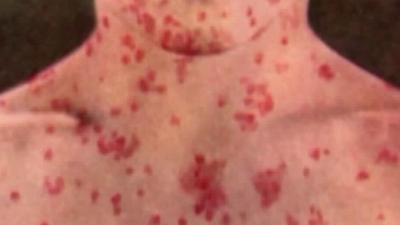 Measles cases surging in California