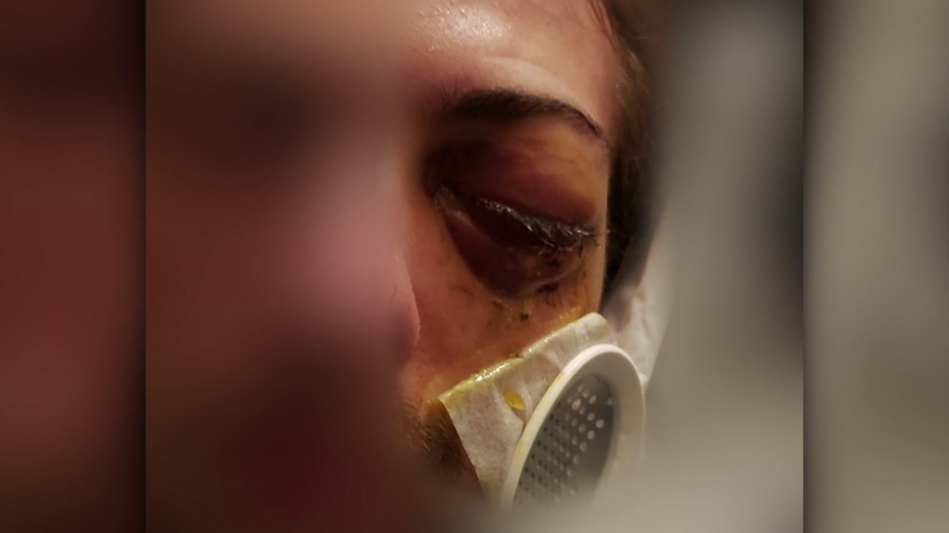 Young man loses vision in eye after bar attack in Capitol Hill
