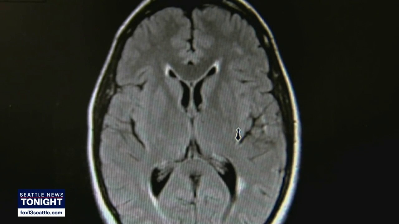 Research shows how movement fights dementia