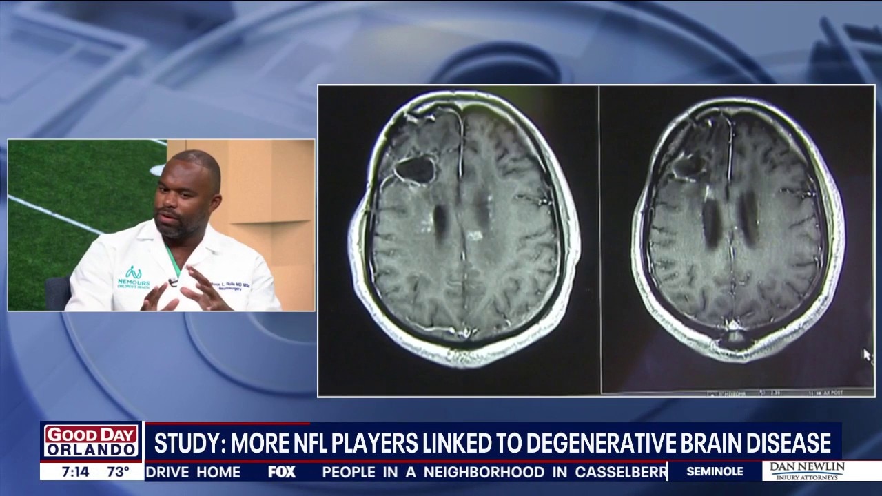 New Study finds 1 in 4 NFL Players Develop CTE