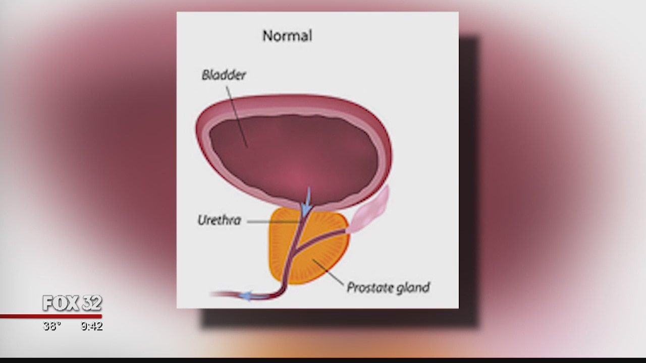 New procedure allows men to avoid surgery to correct an enlarged prostate