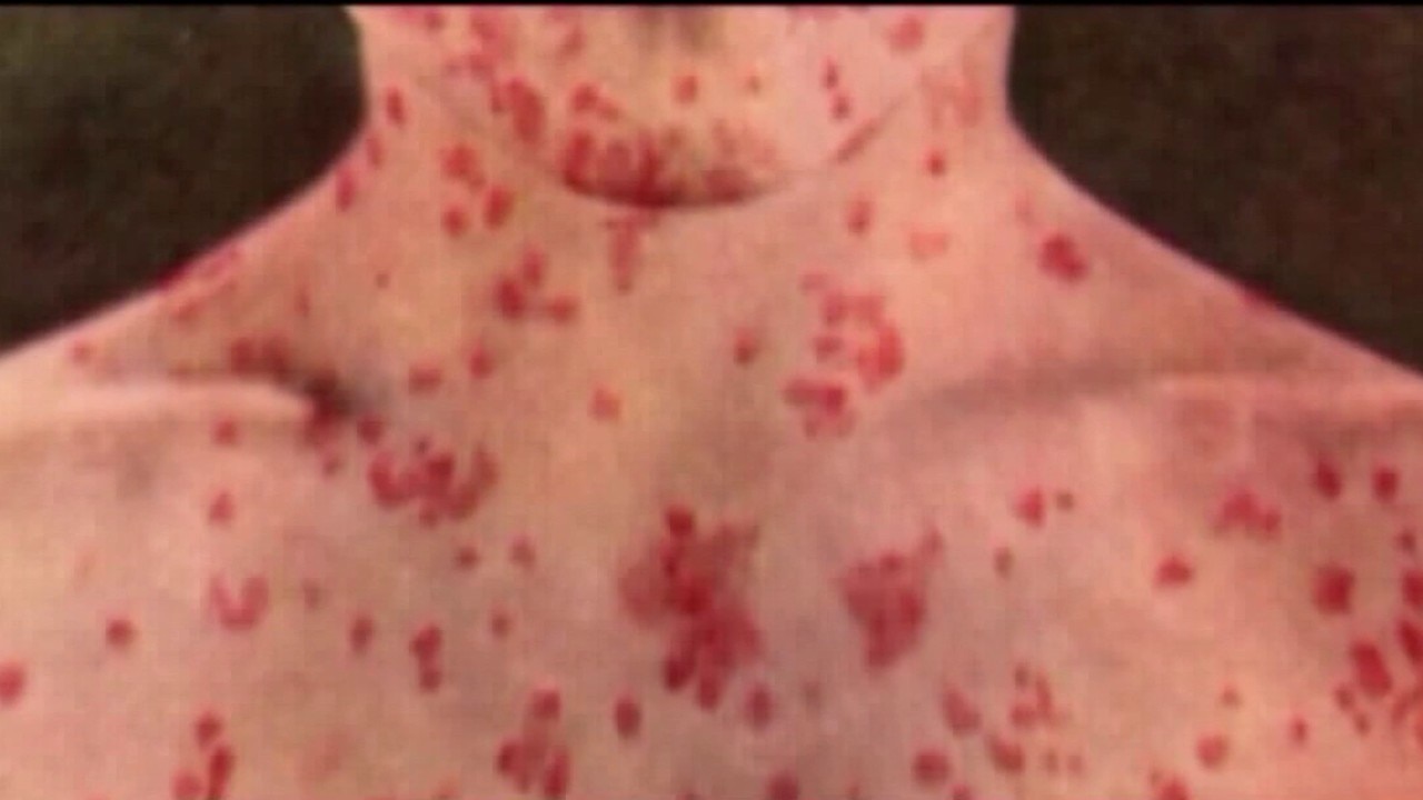 Measles case in the South Bay 