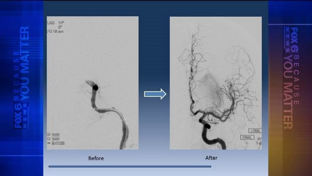 Stroke awareness: Signs and symptoms everyone should know