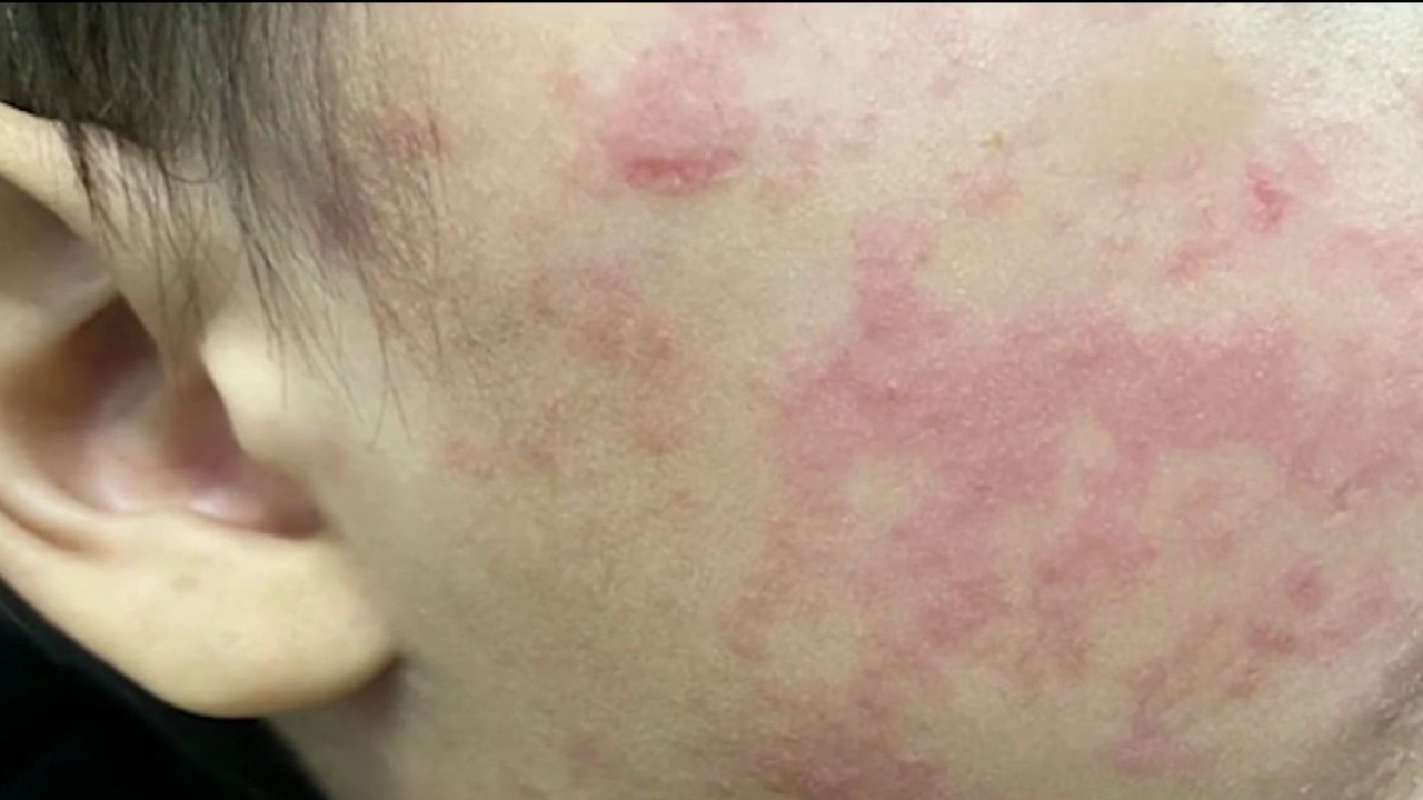 Pennsylvania governor blames Trump Admin for measles deaths