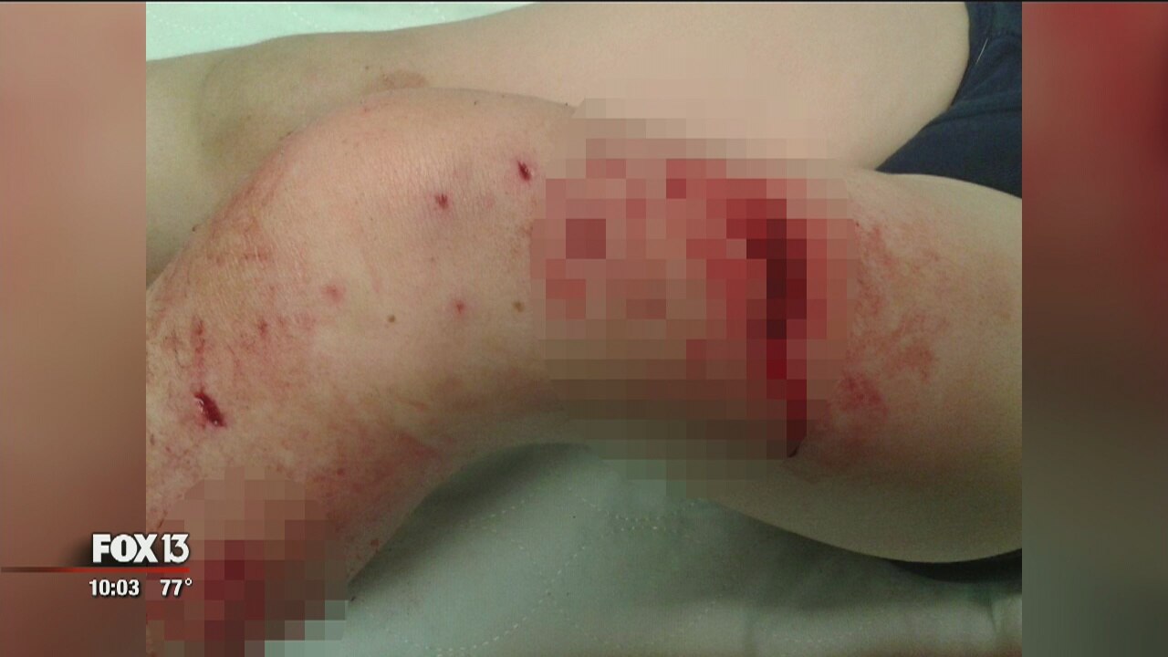 Neighbor's dog attacks little boy