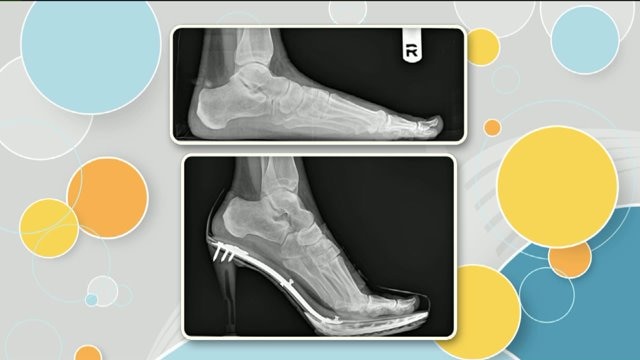 Do high heels hurt your feet? Tips for wearing heel wihtout all the pain
