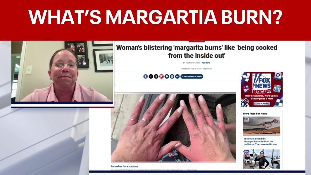 "Margarita burn" and the symptoms to look out for