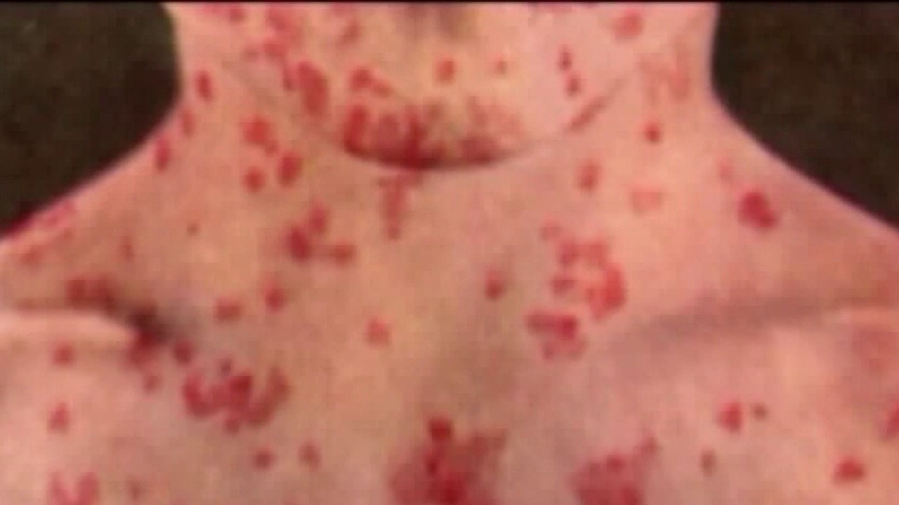 Measles exposure at Universal Studios Hollywood