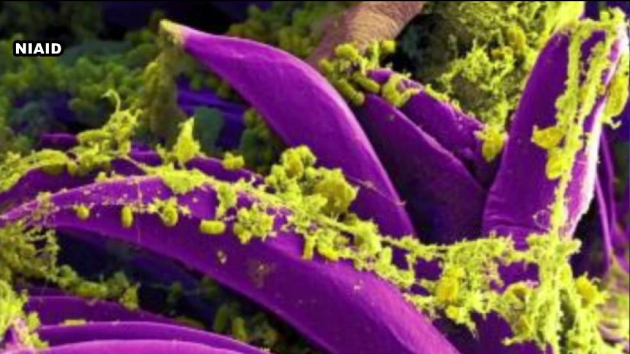 U.S. monitoring Russia plague death
